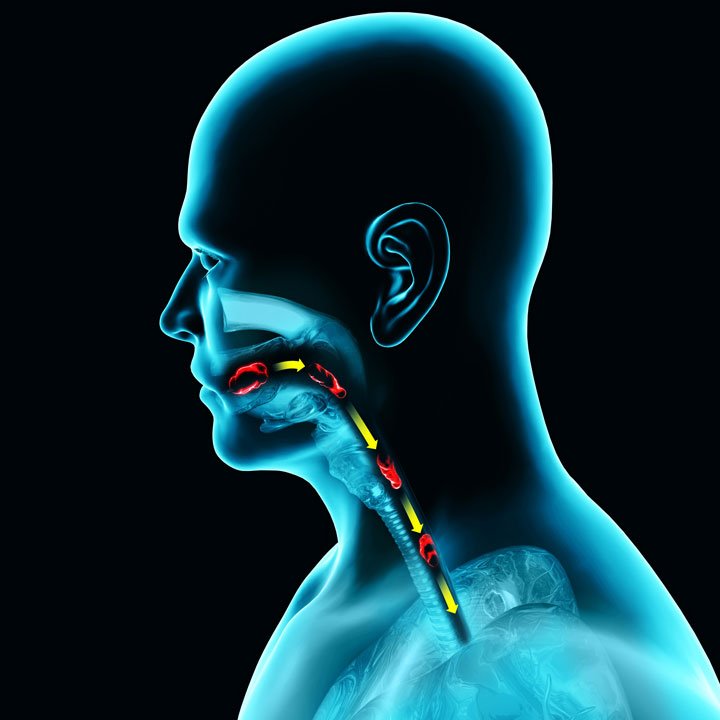 dysphagia